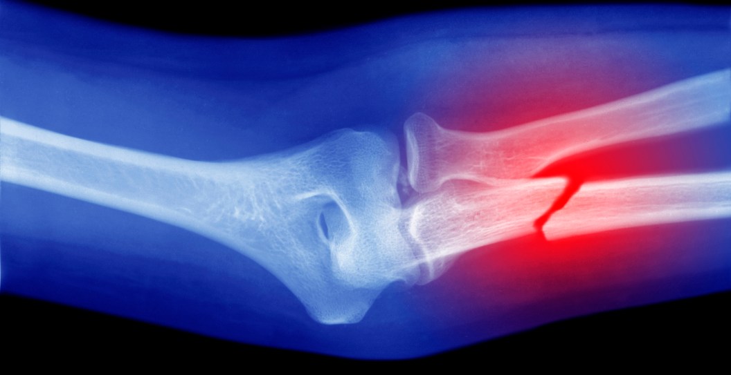 Popular Drug, Second Most Commonly Prescribed To Older Adults, Linked To Bone Loss