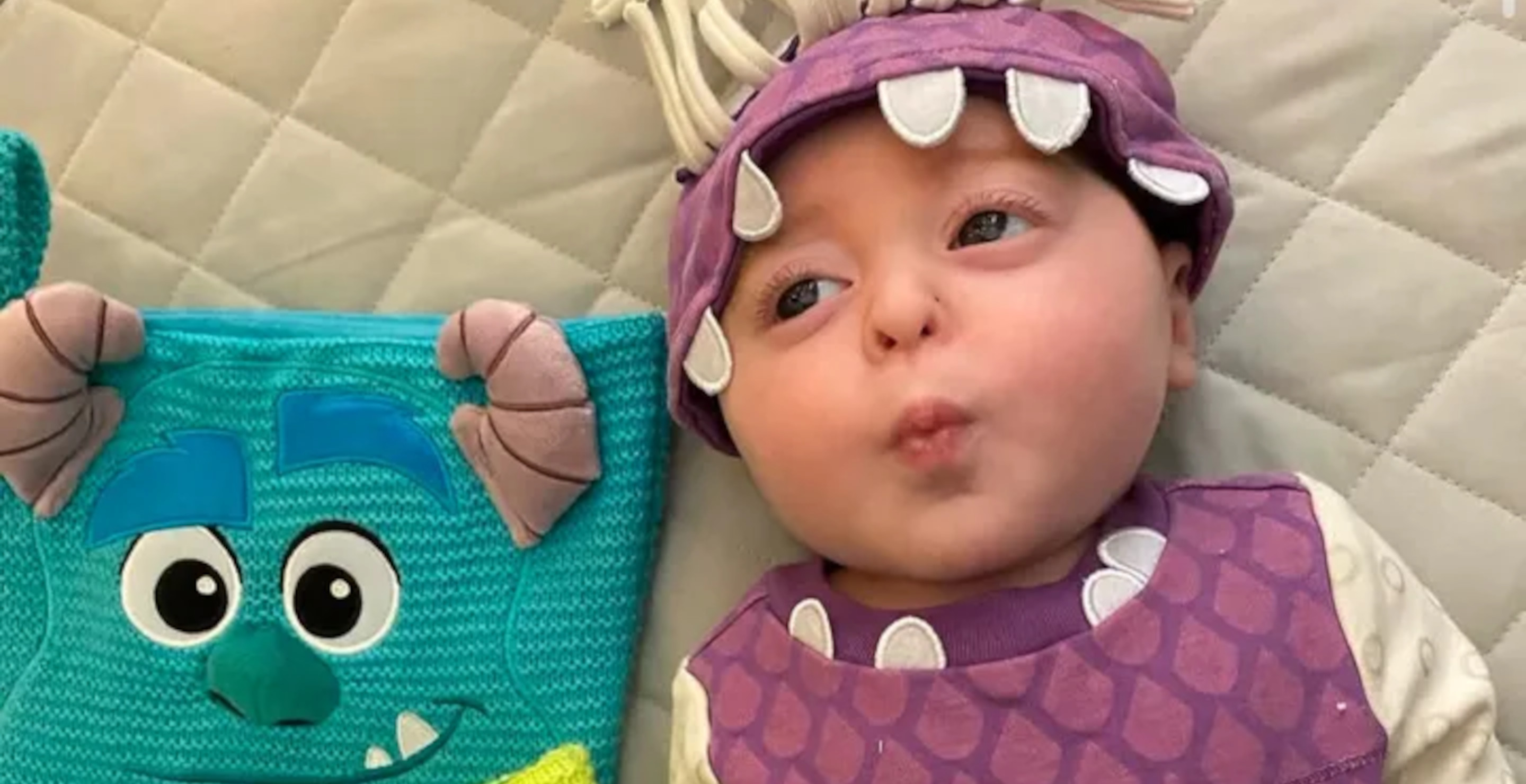 Baby Has Left Side Of His Brain Removed At 4 Months Old