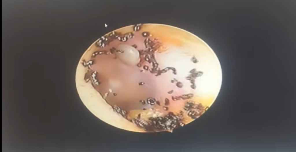 Ear Ticks