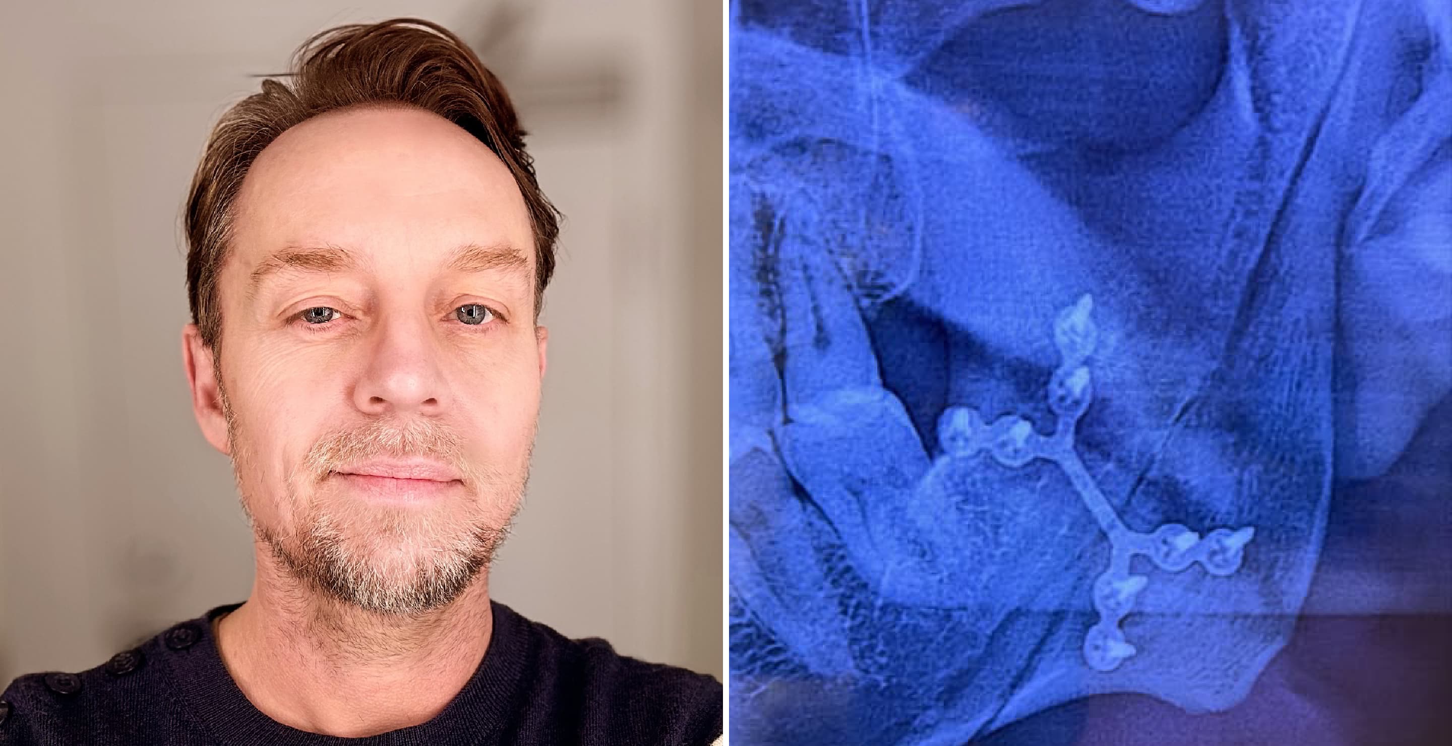 Darren Hayes Broken Jaw