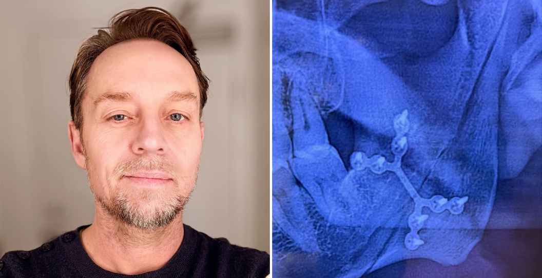 Darren Hayes Broken Jaw