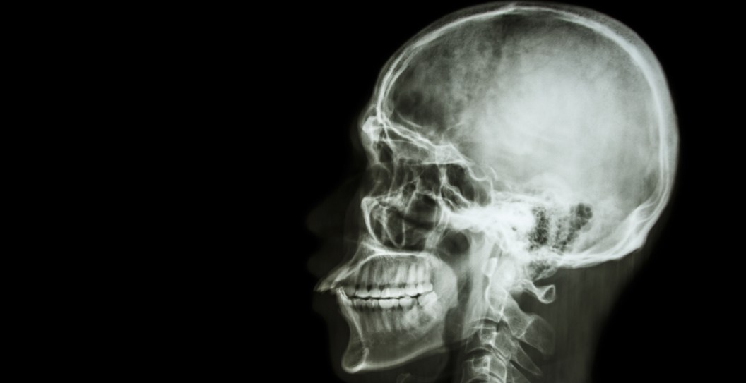 Farmer Has Skull Reattached After Suffering Internal Decapitation During Car Wreck