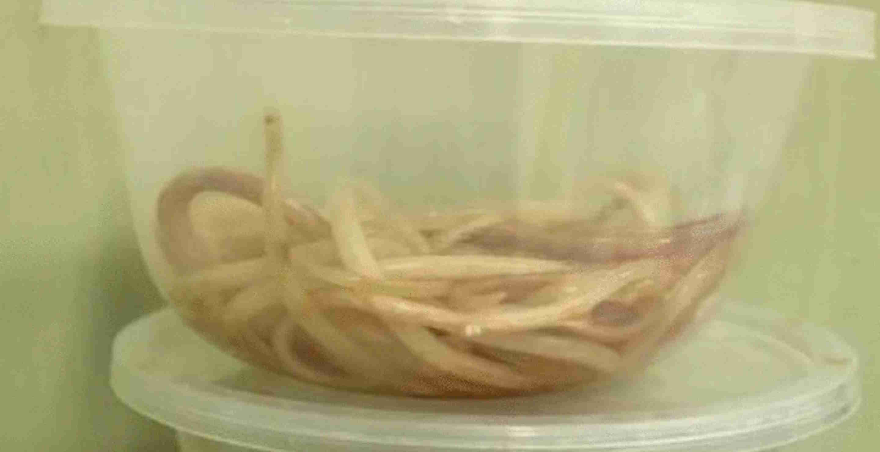 Doctors Horrified To Find Giant Worms Growing In Young Boy’s Belly And I May Never Sleep Again