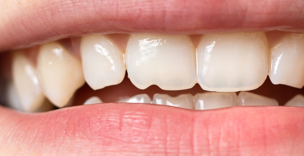 Insurance Refused to Pay After Woman Chipped Her Tooth on Tortilla Chip