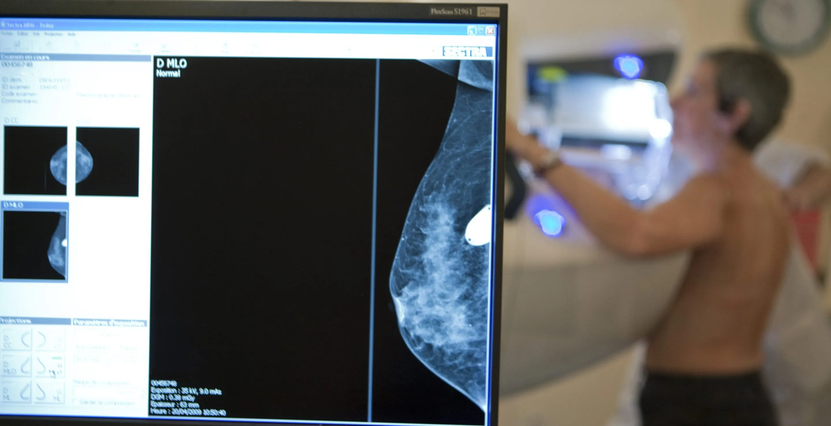 breast cancer