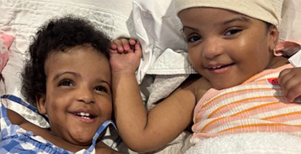 Twins Born Joined at the Head See Each Other Face-to-Face for First Time