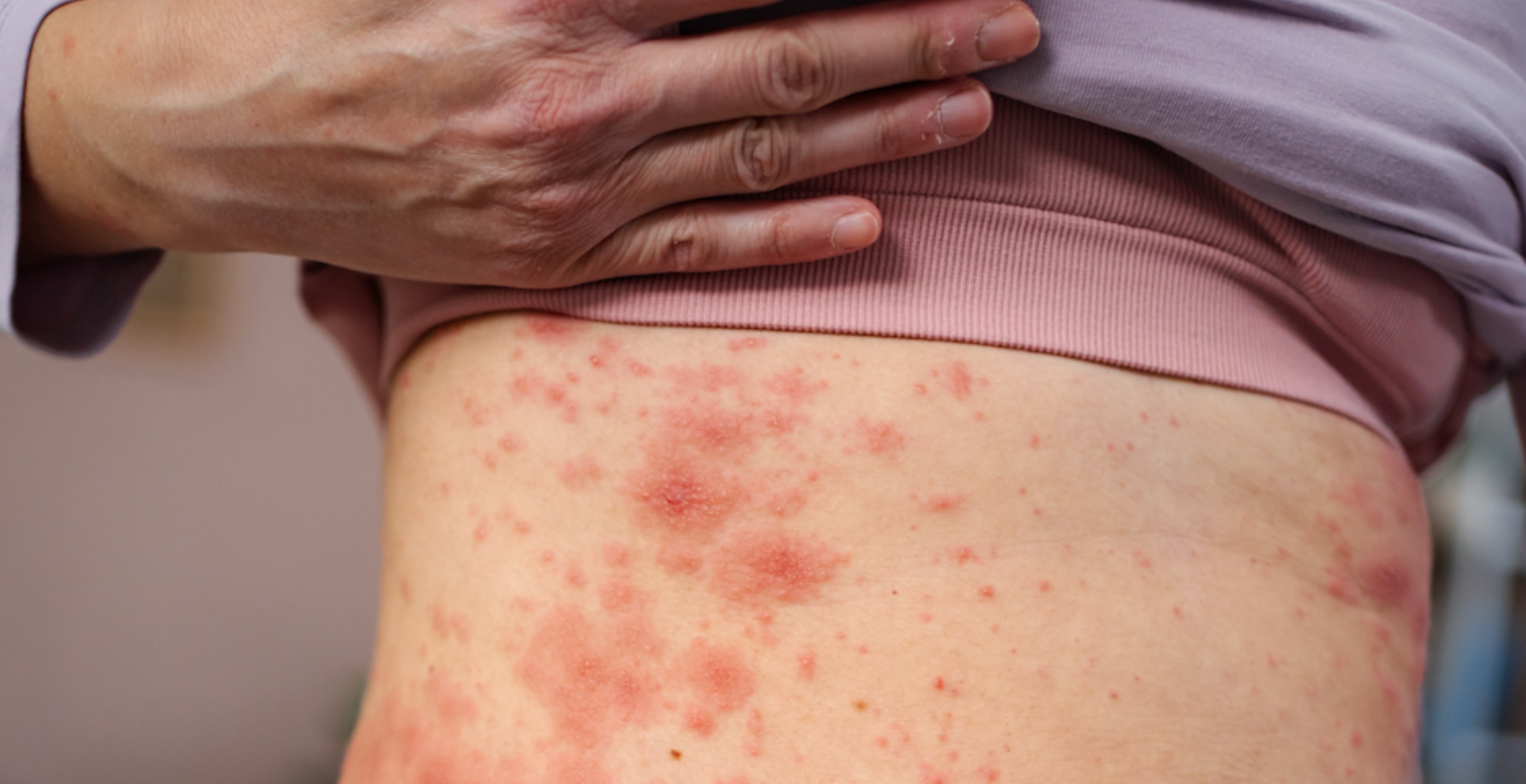 Measles Outbreak Reaches Grim Milestone as Sixth Death Reported in One State