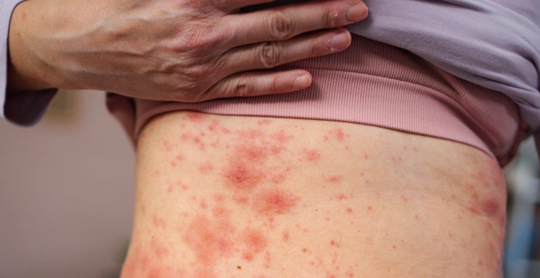Measles Outbreak Reaches Grim Milestone as Sixth Death Reported in One State