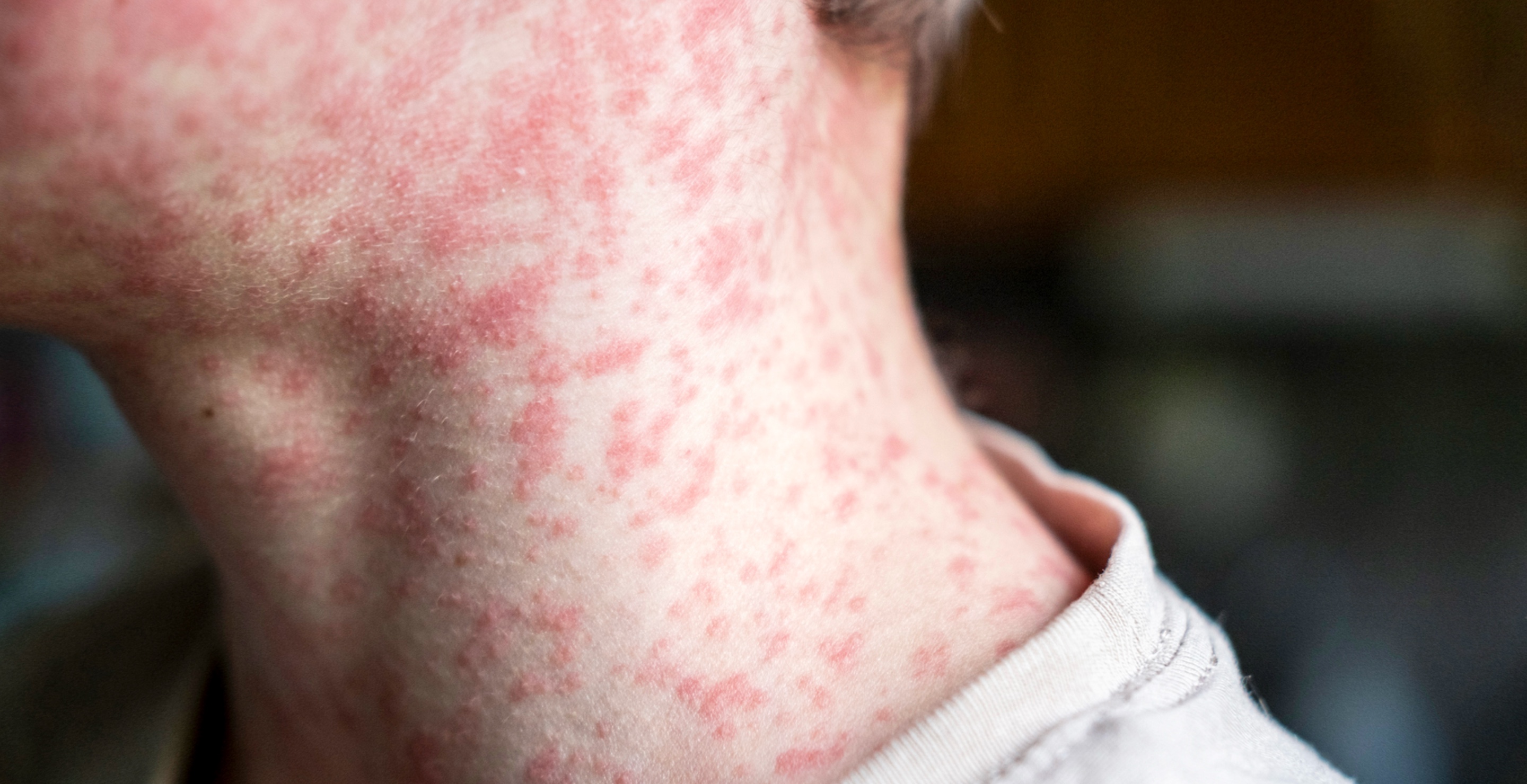Pennsylvania Reports 5th Measles Death as Cases Surge Toward 1,000
