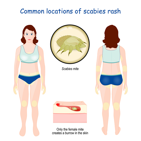 Common locations of scabies rash. Close-up of Scabies mite. Magnification of cross section of skin layers. female mite that creates a burrow in the skin. infographic. Vector illustration